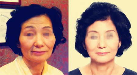 面部提升术