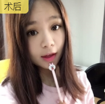 双眼皮手术