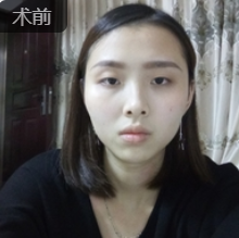 双眼皮手术