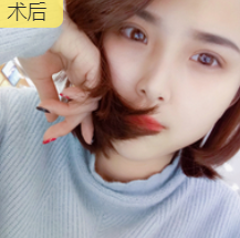双眼皮手术
