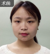 双眼皮手术