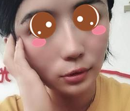长效玻尿酸