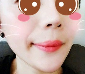 长效玻尿酸