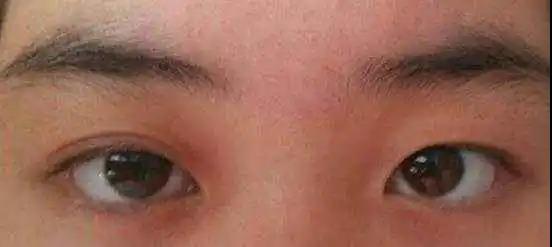 双眼皮手术