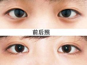 双眼皮手术