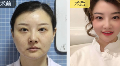 面部提升术