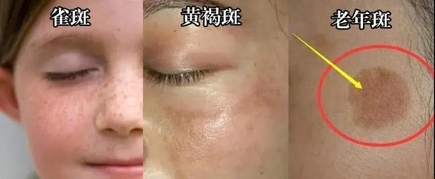 皮秒祛斑