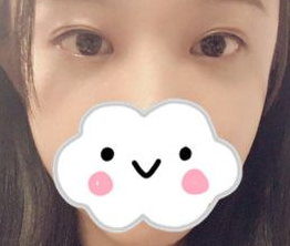 去眼袋手术