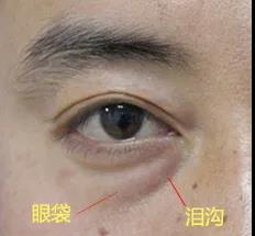 去眼袋手术
