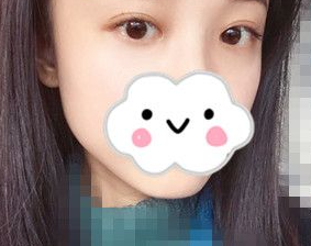 去眼袋手术