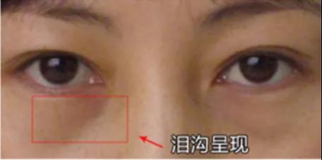 去眼袋手术