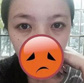 去眼袋手术
