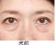 去眼袋手术