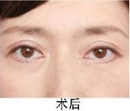 去眼袋手术