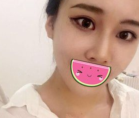去眼袋手术
