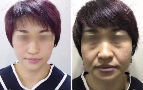 面部提升术
