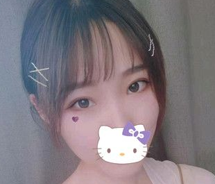 双眼皮手术