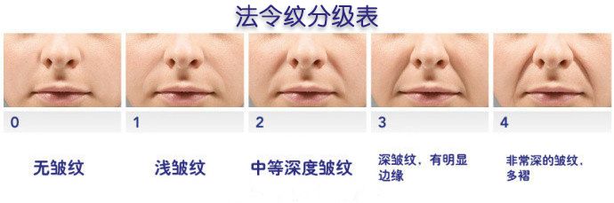 面部提升术