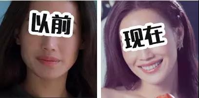 面部提升术