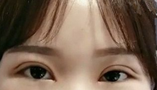 双眼皮手术