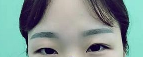 双眼皮手术