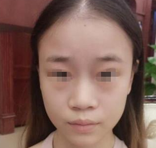 隆鼻手术