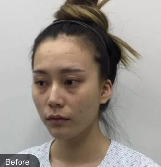 去眼袋手术