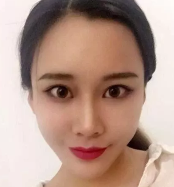 去眼袋手术