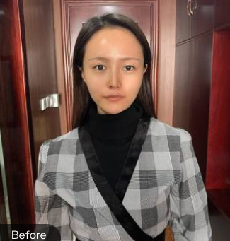 双眼皮手术