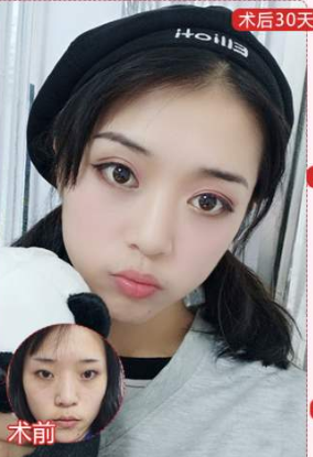 双眼皮手术