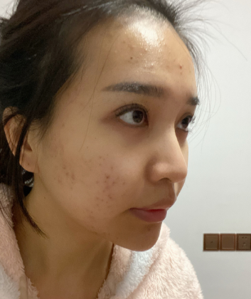 长效玻尿酸