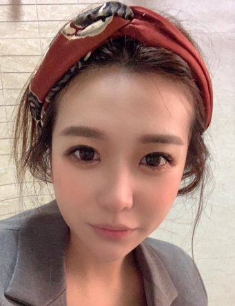长效玻尿酸