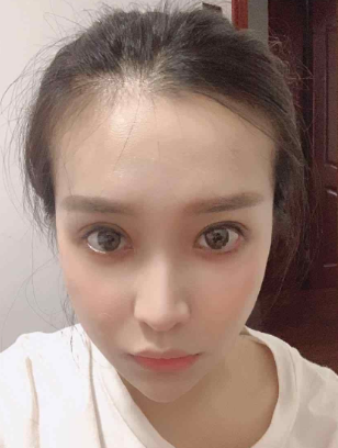 长效玻尿酸