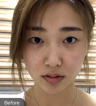 双眼皮手术