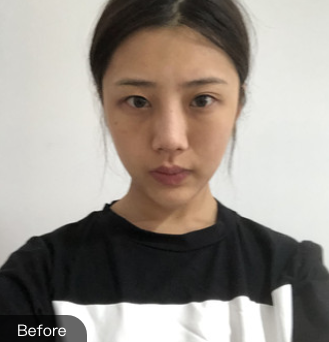 去眼袋手术