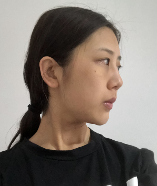 去眼袋手术