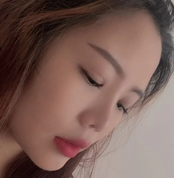 长效玻尿酸