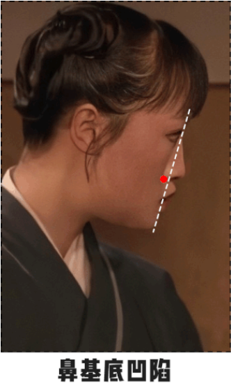长效玻尿酸