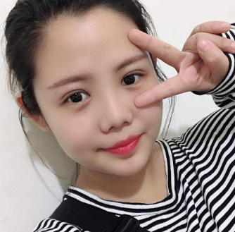 长效玻尿酸