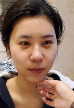 长效玻尿酸