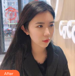 长效玻尿酸