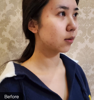 长效玻尿酸