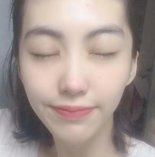 去眼袋手术
