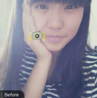 双眼皮手术