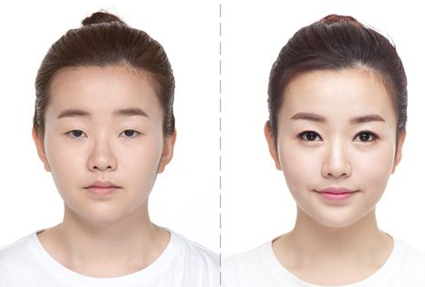 双眼皮手术
