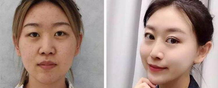 双眼皮手术