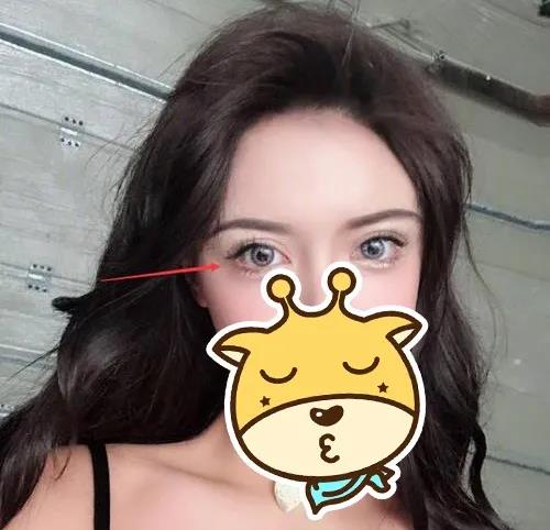 双眼皮手术