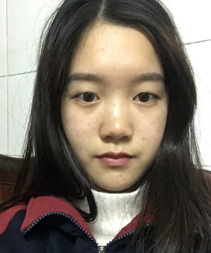 双眼皮手术