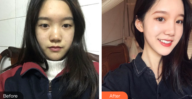 双眼皮手术