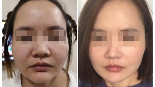 面部提升术